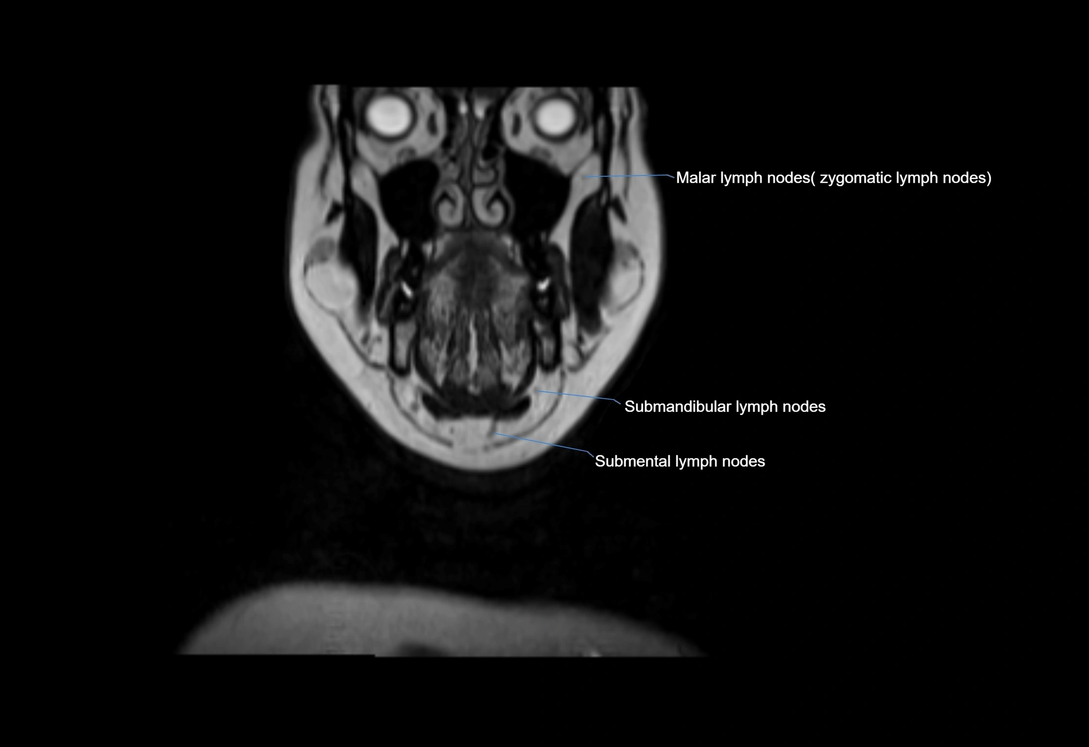 Neck coronal lymph node cross sectional MRI anatomy 3T MRI  image-img-00001-00061.webp